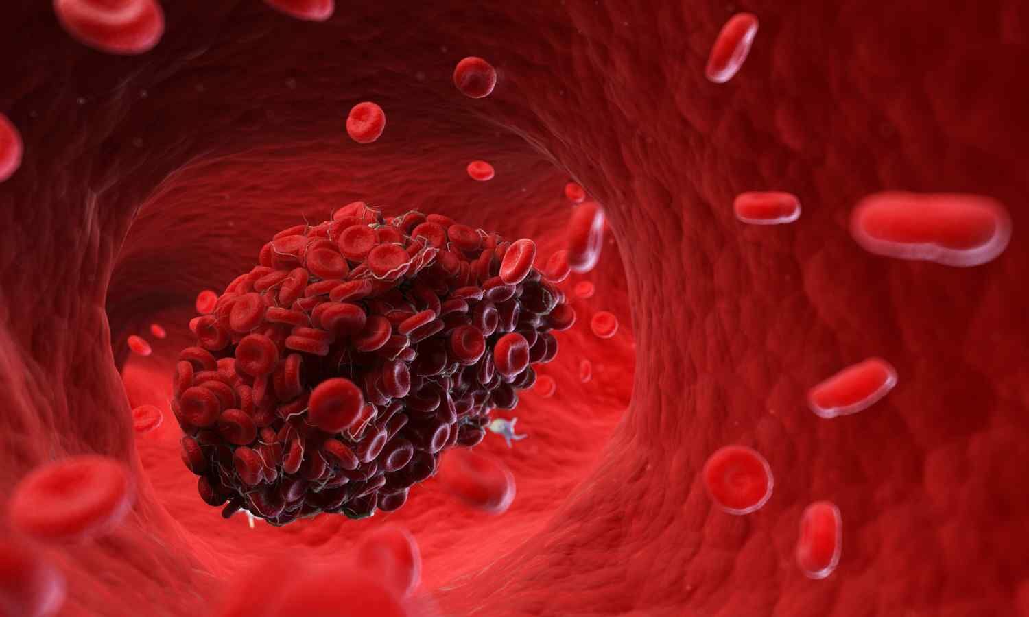 268611 blood clots 50.jpg