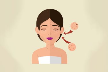 best facials to remove pigmentation 1736136996062.jpg
