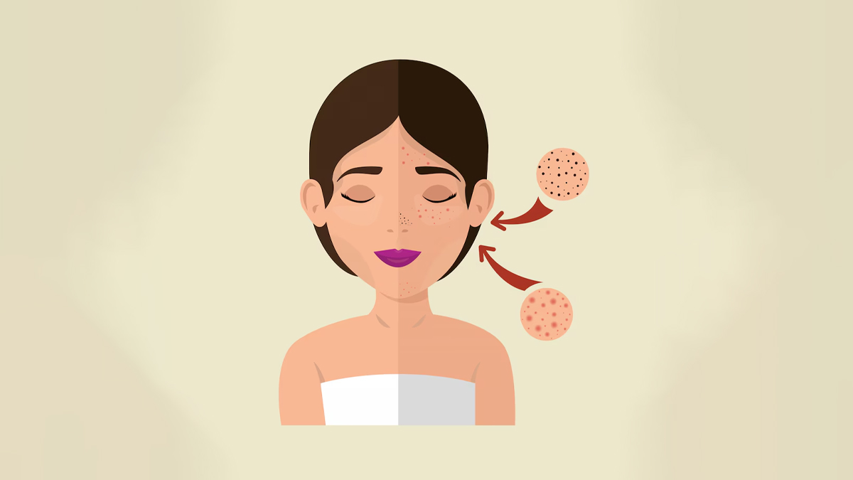 best facials to remove pigmentation 1736136996062.jpg