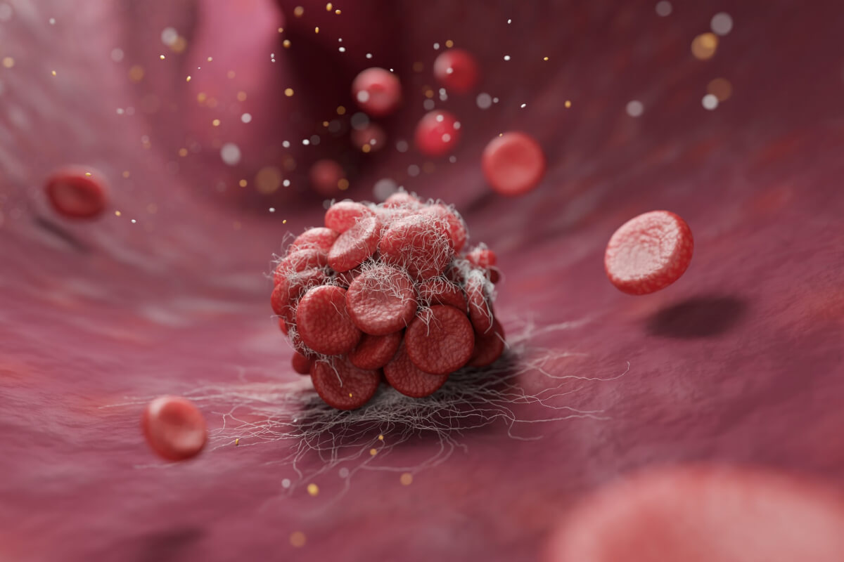 blood clot scaled.jpg