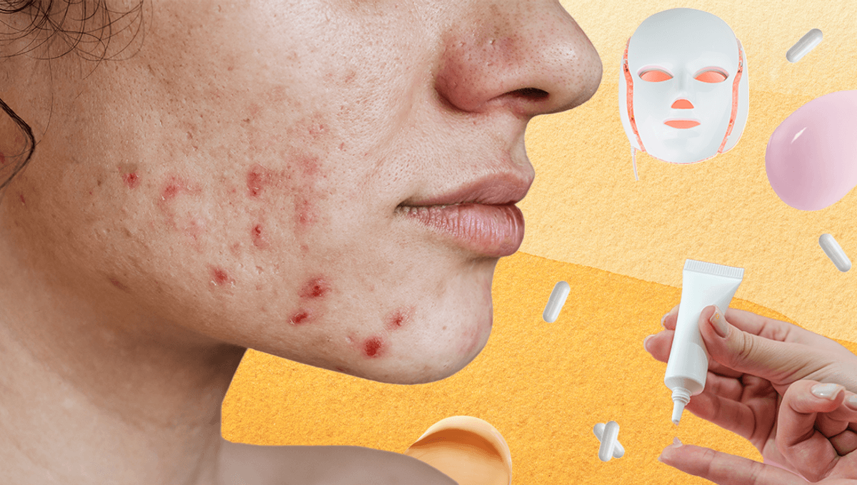 acne meta.png